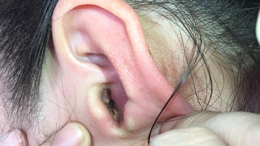 耳朵医生提示：常见耳科疾病的症状、诊断与治疗     